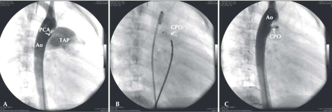Figure 2 – Steps of the procedure. In A, descending aortography in the right anterior oblique incidence showing a conic patent ductus arteriosus (type  A) with 2.5  mm in its smaller diameter, in the pulmonary entrance