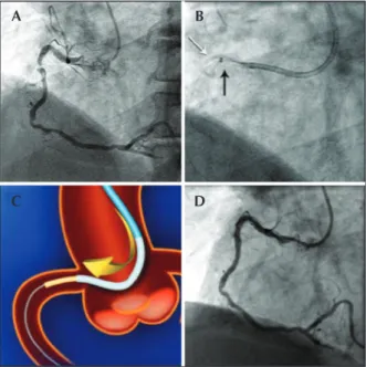 Figure 1 – In A, transradial coronary angiography showing criti- criti-cal stenosis and thrombus in the proximal right coronary artery