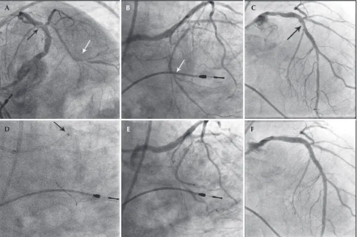 Figure 2 – In A, B, and C, coronary angiography via the femoral approach shows a left coronary artery with a long trunk and 40% stenosis in the  body