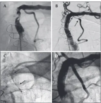 Figure 3 – In A, severe stenosis of the left subclavian artery before  the origin of the left internal thoracic artery