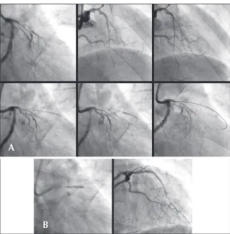 Figure 5 – Chronic total occlusion of the left anterior descending artery. 