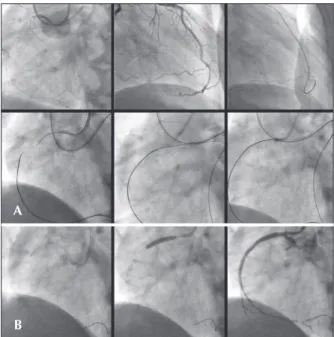 Figure 6 – Chronic total occlusion in the right coronary artery. In A,  the Corsair microcatheter is inserted via the epicardial collateral and  is advanced retrogradely up to the distal portion of the occlusion