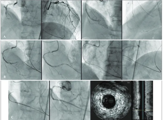 Figure 14 – In A, the following are shown in sequence: right coronary with a 90% lesion in the medium tertium, followed by occlusion in the  distal tertium; left anterior descending artery emitting a 3-degree collateral through septal branches; unsuccessfu