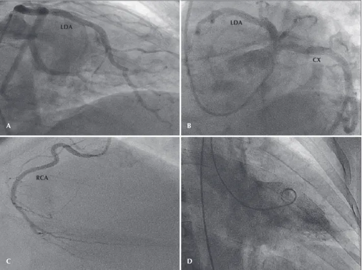 Figure 3 – Selective characterisation and opaciication of the anomalous  vessel originating from the descending thoracic aorta.
