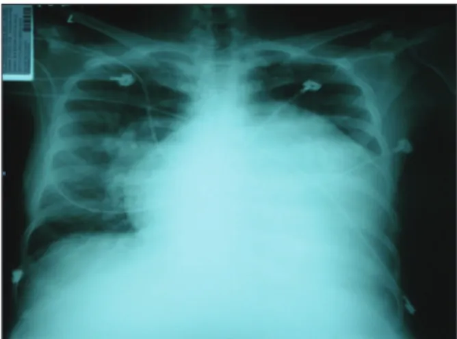 Figure 1 – Chest X-ray on admission.