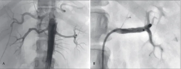 Figure 3 – Renal sympathetic denervation procedure. In A, abdominal aortography showing the anatomical viability of the procedure