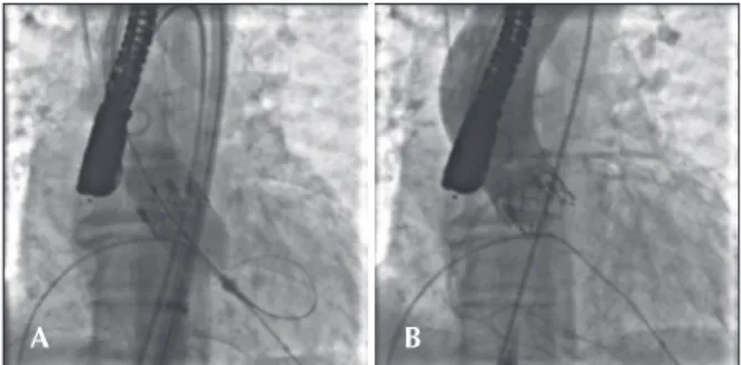 Figure 1 – (A) Release of Edwards SAPIEN XT valve after inlating the  balloon catheter