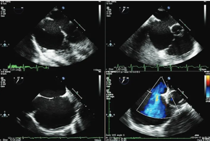 Figure 2 – Two­dimensional echocardiographic assessment of atrial septal defect, showing its favorable aspect for percutaneous treatment