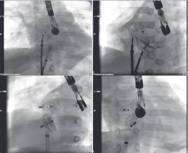 Figure 5 – Fluoroscopy demonstrating the simultaneous positioning of two Amplatzer   prostheses (ASO and Cribriform) in the interatrial septum
