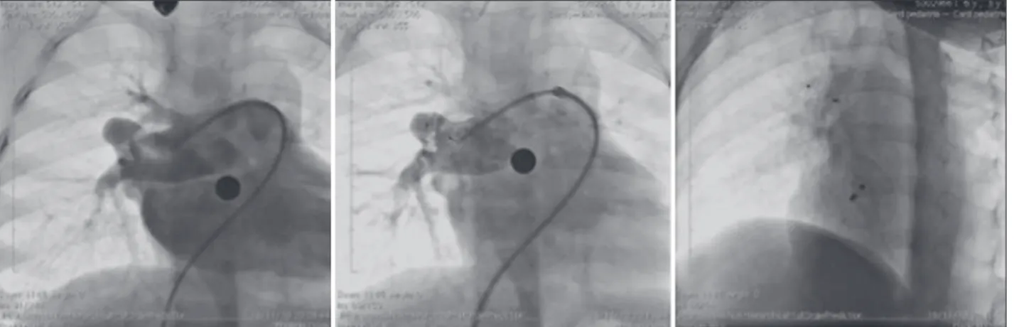 Figure 7 – To the left, coronary angiography demonstrating the presence of large pulmonary arteriovenous istula originating from the middle lobar  branch of the right pulmonary artery
