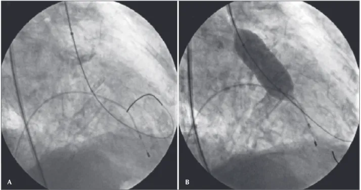 Figure 2. Control aortography in left anterior oblique projection, show- show-ing only mild aortic regurgitation.