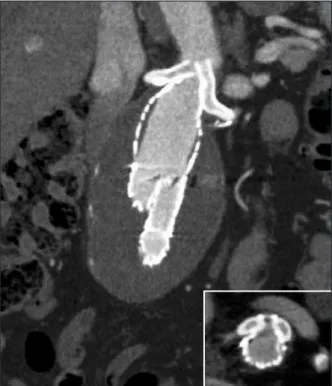 Figura 3. Angiotomografia de aorta abdominal, em corte coronal,  demonstrando o bom acoplamento entre a endoprótese e os stents  revestidos