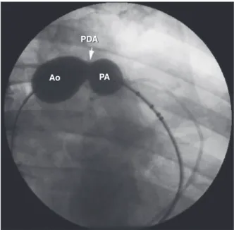 Figure 1 – Ductus arteriosus type A, of large calibre (8 mm), outlined  with the help of a 24-mm AGA sizing balloon