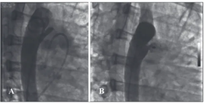 Figure 3 – In A, descending aortography in right anterior oblique  view, showing ductus arteriosus type E with signiicant constriction in  the pulmonary end