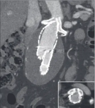 Figure 3 – CT angiography of the abdominal aorta in coronal sec- sec-tion, showing adequate coupling between the endoprosthesis and the  coated stent