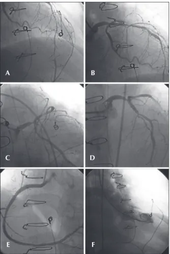 Figure 2 – In A, stent implantation in left main coronary artery lesions  and proximal left anterior descending artery