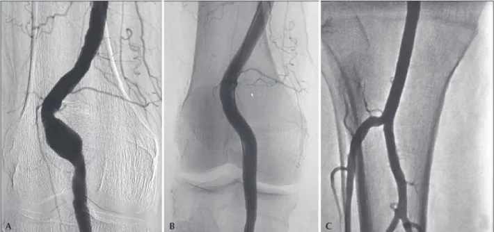 Figure 1 – Endovascular treatment of popliteal artery aneurysm. (A) Fusiform aneurysm of the supra-articular popliteal artery