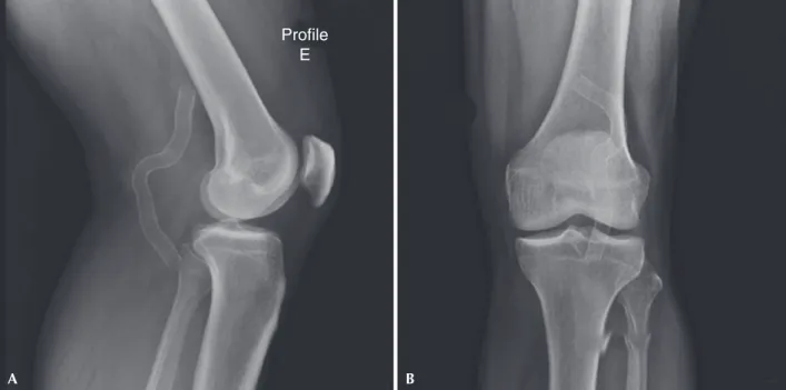 Figure 3 – Follow-up X-ray after endoprosthesis implantation. (A) Left proile with knee in semilexion