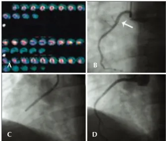 Figure 1 – In A, myocardial perfusion scintigraphy, performed in the  presence of chest pain, shows hypoperfusion in the inferior wall