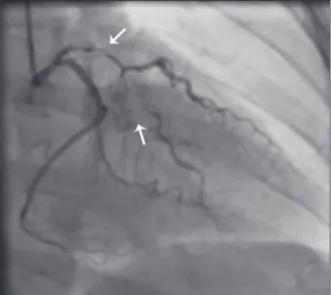 Figure 5 – Coronary angiography demonstrates spontaneous dissec- dissec-tion in the left main coronary artery, with the dissecdissec-tion extending to  the left anterior descending artery and left circumlex artery (arrows).