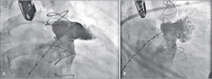 Figure 1 – Angiography of the left atrial appendage. In A, right anterior oblique view with cranial tilt shows the appendage anatomy, with emphasis  on the ostium and target region