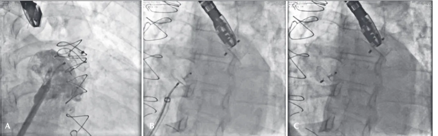 Figure 2 – Prosthesis implantation. In A, injection performed through the long sheath shows that the prosthesis is adequately positioned and that  the disk completely obstructs the atrial appendage ostium