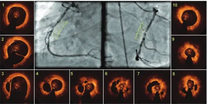 Figure 1 – Angiography and optical coherence tomography. Angiography of the right coronary artery in two orthogonal projections, showing in- in-traluminal haziness and preserved distal flow (TIMI 3)