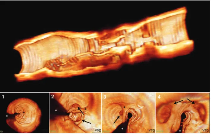 Figure 2 – Three-dimensional reconstruction of optical coherence tomography images. In the top panel, three-dimensional image of the open vessel  in the longitudinal direction, showing multiple orifices and trajectories along the stenosis