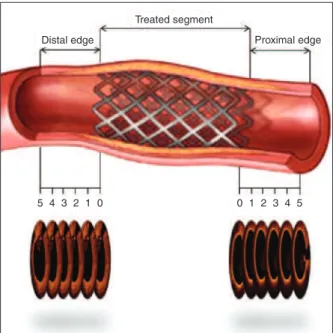 Figure 1 – Deinition of the analysis’ segments. The regions comprising  5 mm distal and proximal to the vascular bioresorbable scaffold limits  were deined as the distal and proximal edge segments, respectively.