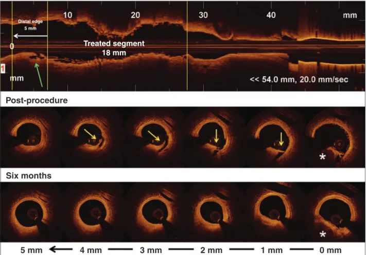 Figure 5 – Example of healed edge dissection. Top panel shows a longitudinal view of optical coherence tomography after the implantation of the  bioresorbable scaffold