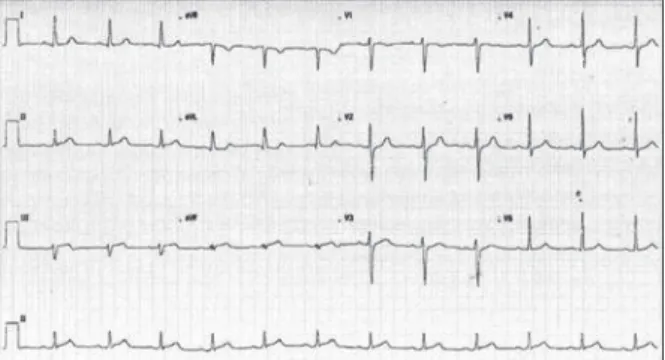 Figure  1 – Admission electrocardiogram: 1  mm ST-segment elevation  in DIII and AVF leads.