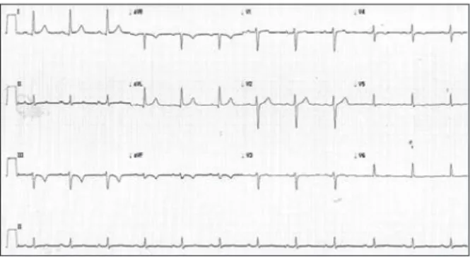 Figure 3 – Electrocardiogram 4 days later, before the new catheteriza- catheteriza-tion, with complete regression of ST elevation and T-wave inversion  in DIII and aVF leads.