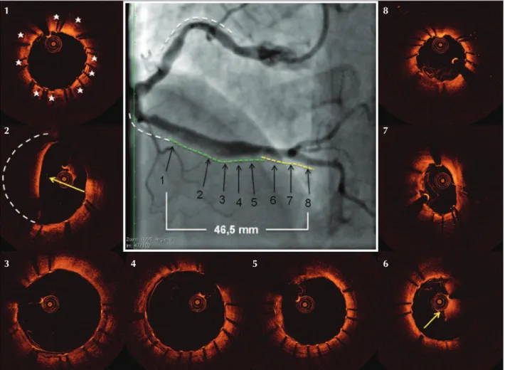 Figure 5 – Control angiography and optical coherence tomography. The previously implanted stents (white lines) and the newly implanted stents  (yellow and green lines) show minimal overlap of the struts and complete segmental coverage