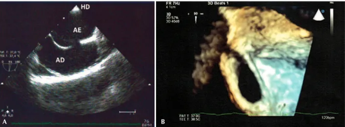 Figure 2 – In A, two-dimensional image of a small ostium secundum type atrial septal defect (osASD) obtained by transesophageal echo