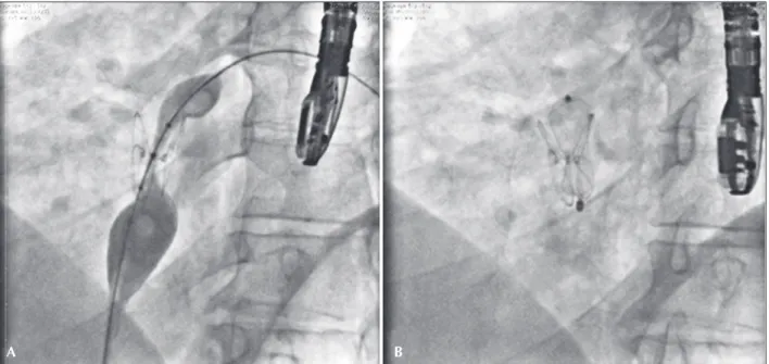 Figure 5 – Patient who had ostium secundum-type atrial septal defect occluded with a HELEX   prosthesis