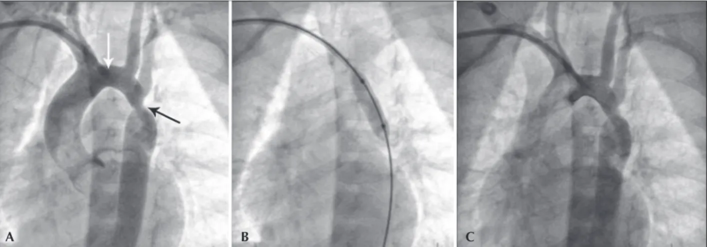 Figure 1 – In A, angiography procedure by axillary access showing aortic coarctation (black arrow) and the ideal position of the sheath in the aortic  arch (white arrow)