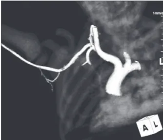 Figure 3 – Control CT scan of right axillary artery, without evidence  of stenosis or dissection at the punctured site.