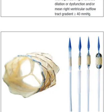 Figure 1 – Left, the Melody™ valve open, showing the arrangement of  bovine jugular vein sutured inside the stent
