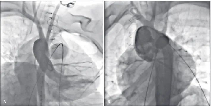Figure 2 – Coronary balloon compression test. There was no detrimental effect to the left-coronary-artery illing in both tests