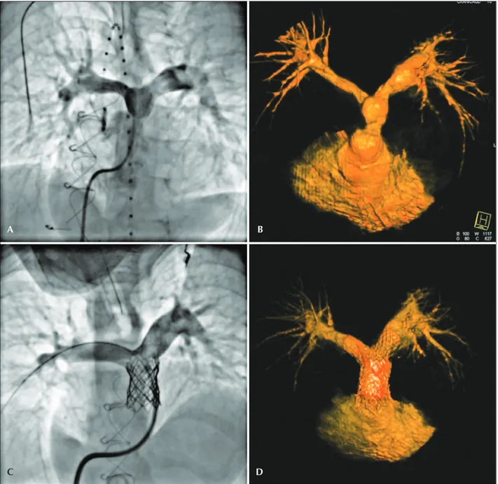Figure 3 – Conventional angiography studies in left anterior oblique projection with cranial angulation in A and C; and rotational angiography stud- stud-ies with three-dimensional reconstruction in B and D, in basal situation (A and B) and, after treatmen