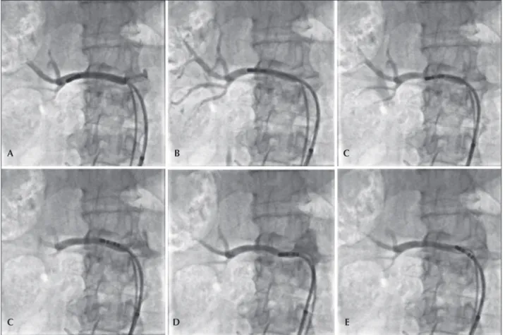 Figure 3 exempliies a quantitative angiography in  right renal artery before and 6 months after  percutane-ous RSD