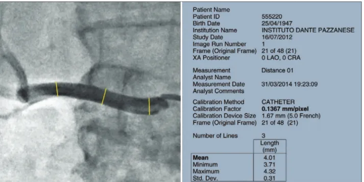 Figure 2 – Left, quantitative angiography measured at three points of the right renal artery, generating a report (right) in which the mean of diameters  was calculated automatically by the program QAngio XA, version 7.3.
