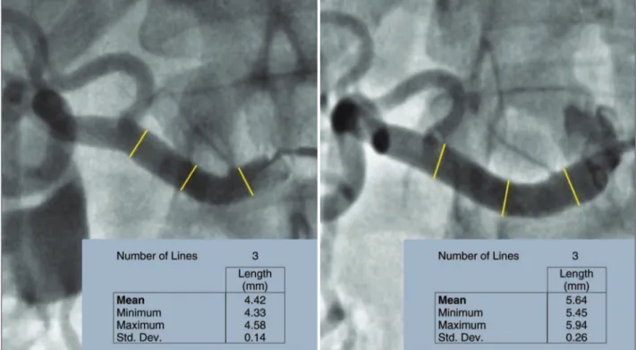 Figure 3 – Quantitative angiography at right renal artery. Left, before percutaneous renal sympathetic denervation with a mean of proximal/middle  third/distal diameters of 4.42 mm