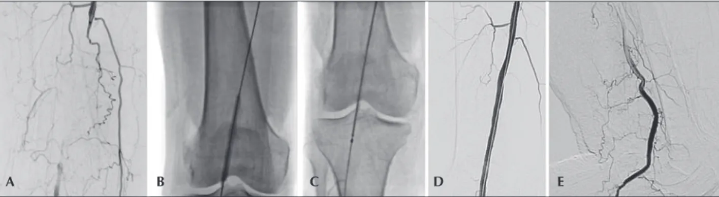 Figure 2 – Angioplasty of popliteal artery with landing zone in the distal segment of this artery