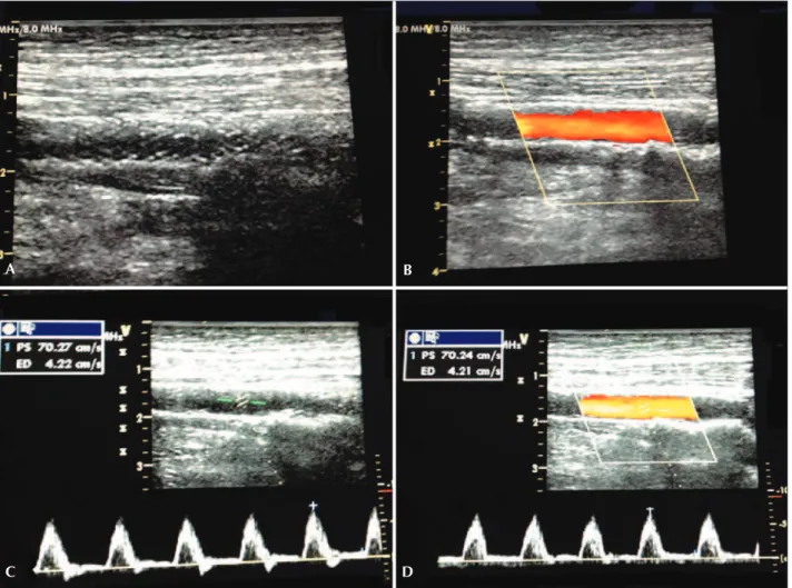 Figure 3 – Ultrasonographic control at 6 months of stenting in the middle segment of popliteal artery