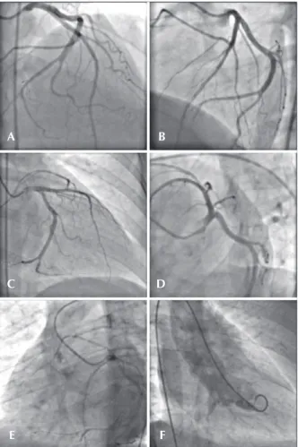 Figure 1 – Right coronary artery, originating from left anterior descend- descend-ing artery after the emergence of the first diagonal branch, coursdescend-ing  to the right, anterior to the pulmonary artery and to right ventricle  outflow