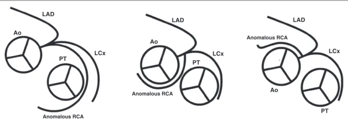 Figure 2 – Schematic representation of the routes of an anomalous right coronary artery