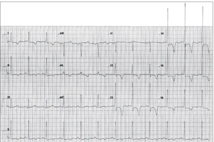 Figure 1 – Electrocardiogram with voltage criteria for left ventricular hypertrophy, secondary changes in ventricular repolarization, and deep inver- inver-sion of T waves.