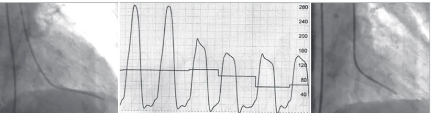 Figure 3 – Left ventricular pressures (center) in the apical (left) and basal (right) chambers, with pressure gradient of 130 mmHg.