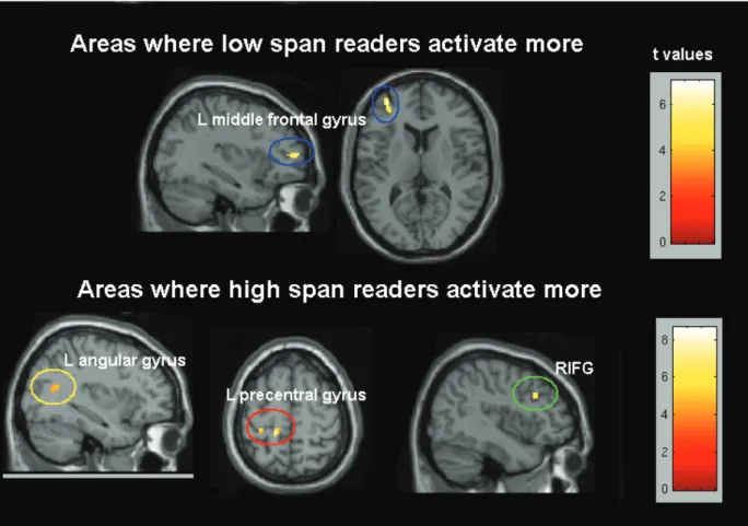 Figure 3. Correlation between brain activation for reading comprehension and reading span scores.